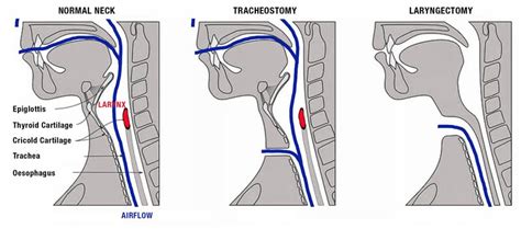 laryngeal tube vs trach.